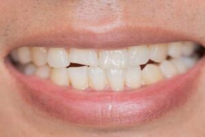 Guía práctica: Cómo reparar un diente roto y restaurar tu sonrisa